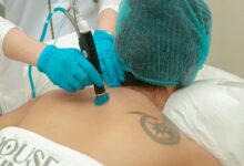 What can be expected from the experience of removing your laser tattoo
