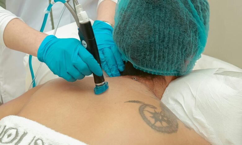 What can be expected from the experience of removing your laser tattoo » 1 What can be expected from the experience of removing your laser tattoo